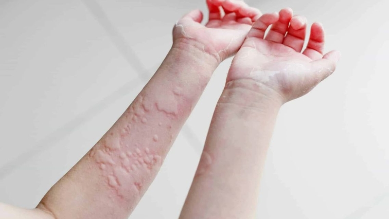 Mề đay tái phát nhiều lần cần được theo dõi và thăm khám sớm