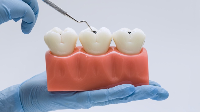 Răng khôn nằm sâu trong hàm và khó vệ sinh làm tăng nguy cơ sâu răng