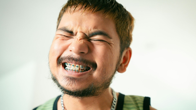 Mới niềng răng đau mấy ngày và cách giảm đau hiệu quả 2