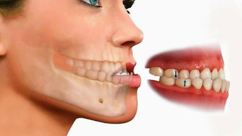 Móm có di truyền không? Có thể khắc phục tình trạng móm không? 2