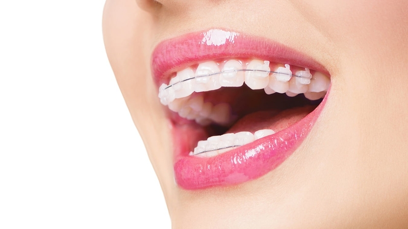 Móm có di truyền không? Có thể khắc phục tình trạng móm không? 3