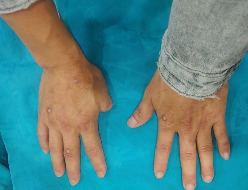 Mỏm cụt ngón tay là gì? Phục hồi chức năng mỏm cụt ngón tay như thế nào? 1