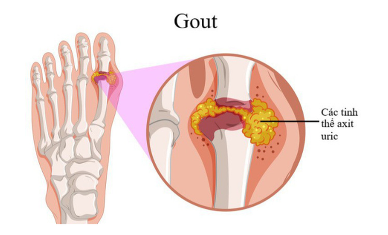 Món ăn cho người bị gout cần hạn chế những gì?
