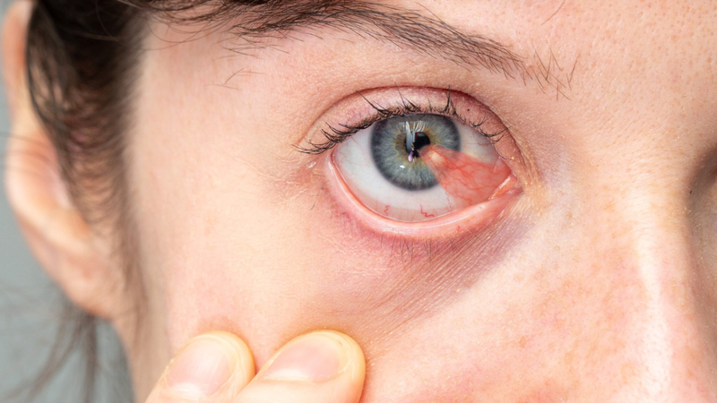 Mộng mắt là gì? Nguyên nhân, triệu chứng và cách phòng ngừa 1