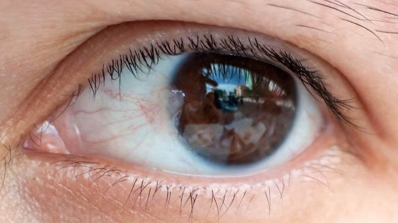 Mộng mắt là gì? Nguyên nhân, triệu chứng và cách phòng ngừa 4