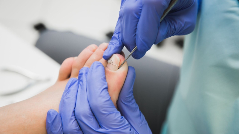 Móng quặp là gì? Nguyên nhân và cách điều trị tình trạng móng quặp4