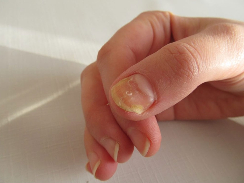 Chữa nấm móng tay bằng lá trầu không có thật sự hiệu quả?