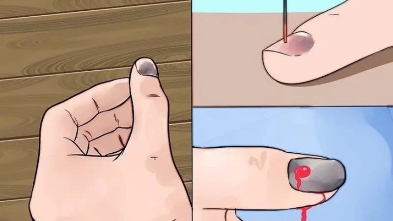 Móng tay bị hư và cách xử lý an toàn, hiệu quả 4