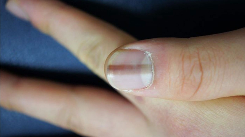 Móng tay có vệt dọc màu nâu thường gặp là do bị chấn thương nhẹ hoặc do tiếp xúc với chất tẩy rửa hàng ngày