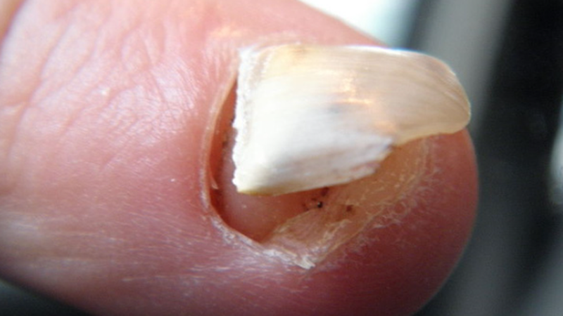 Móng tay bị tách khỏi thịt nguyên nhân do đâu? 1