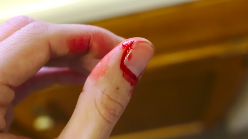 Móng tay bị tách khỏi thịt nguyên nhân do đâu? 2