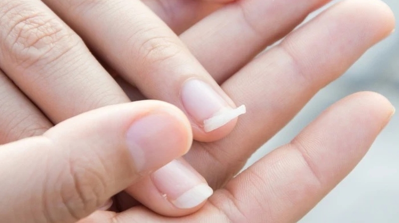 Móng tay bị tách khỏi thịt nguyên nhân do đâu? 3