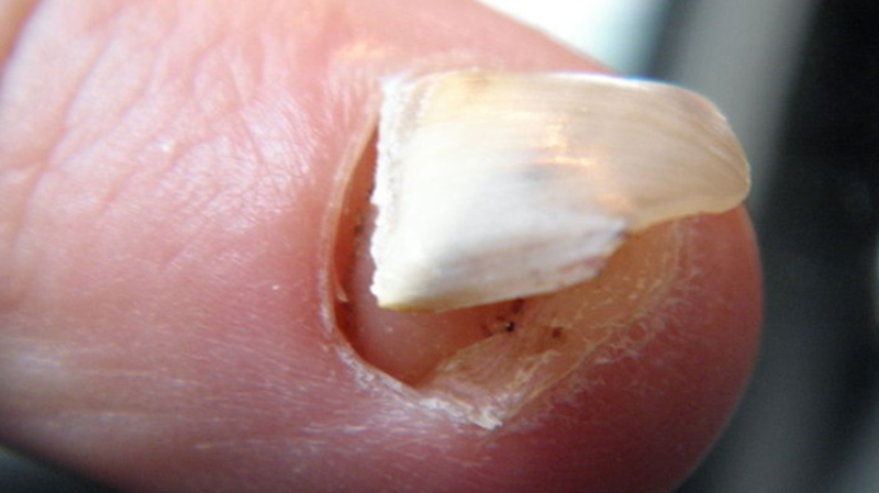 Móng tay bị tụt dần là dấu hiệu của bệnh gì và cách điều trị? 1