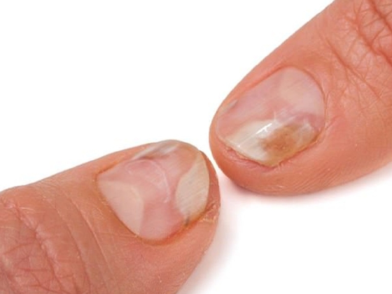 Các thay đổi ở móng của người bệnh ung thư 1