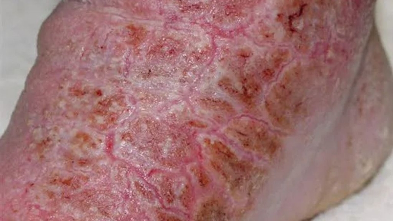 Morgellons là bệnh gì? Nguyên nhân và cách điều trị bệnh? 1