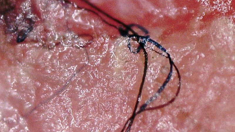 Morgellons là bệnh gì? Nguyên nhân và cách điều trị bệnh? 2
