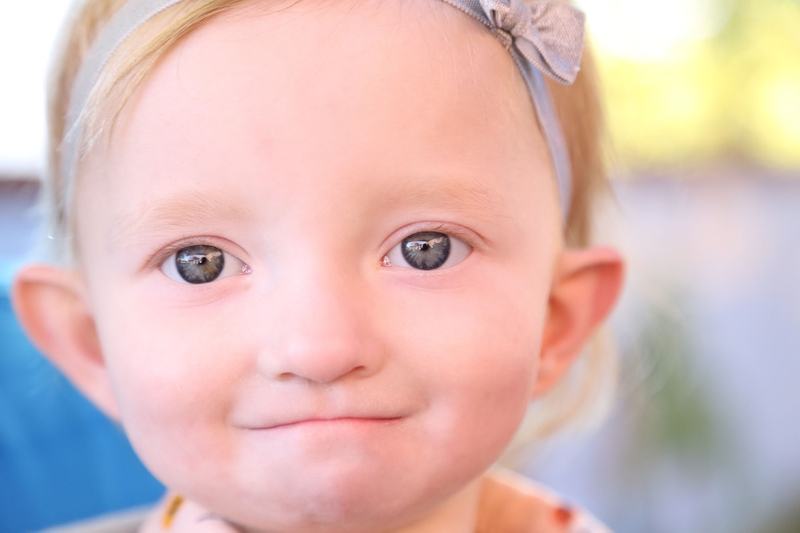 Một số bệnh do bất thường nhiễm sắc thể gây ra bạn nên biết 4