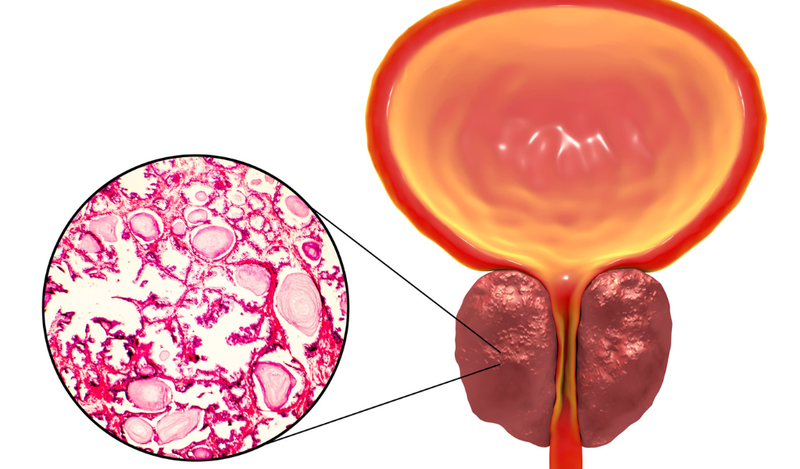U xơ tiền liệt tuyết là bệnh gì?