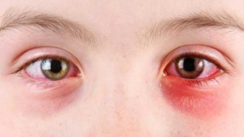 Một số cách phòng tránh bệnh đau mắt hột hiệu quả 1