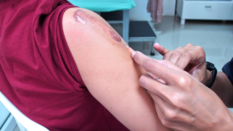 Tiêm corticosteroid ức chế tổng hợp collagen, giúp sẹo lồi mờ và phẳng hơn