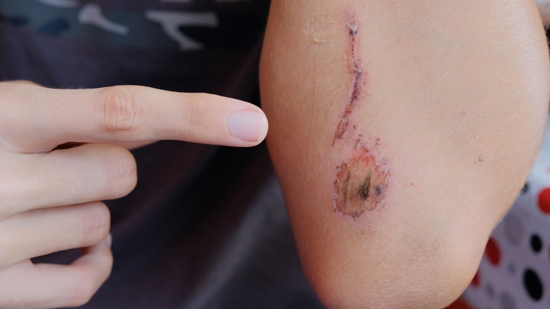 Khi có vết thương hở, rửa ngay bằng nước muối sinh lý để tránh nhiễm ttrùngvaf thành sẹo lồi