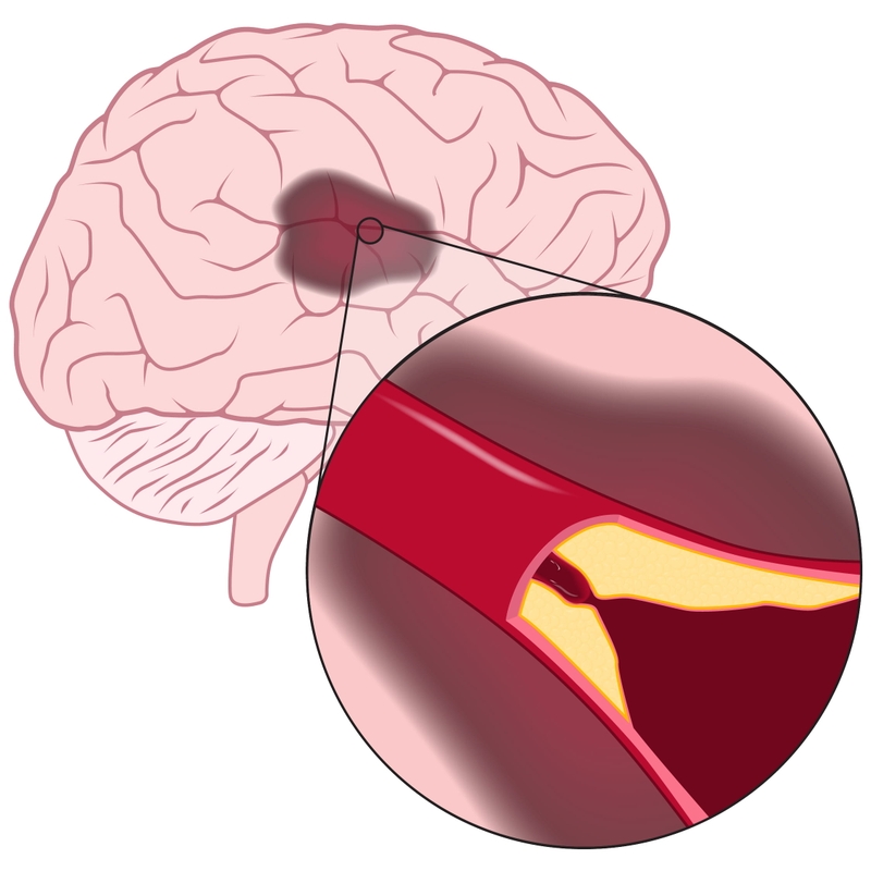 Một số cách trị thiếu máu não tại nhà mà bạn cần biết1
