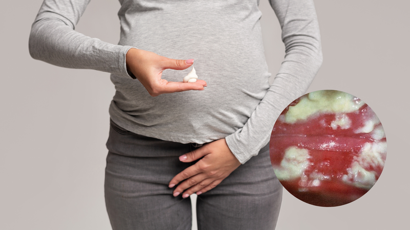 Một số hình ảnh ngứa vùng kín 3