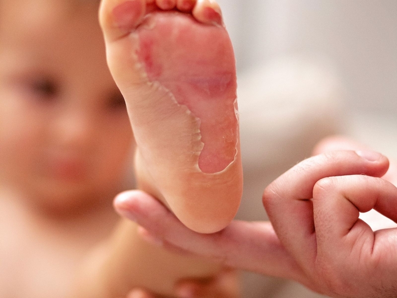 Trẻ em bị bỏng có thể chia làm 3 cấp độ lần lượt&nbsp;là bỏng cấp độ 1, 2, 3