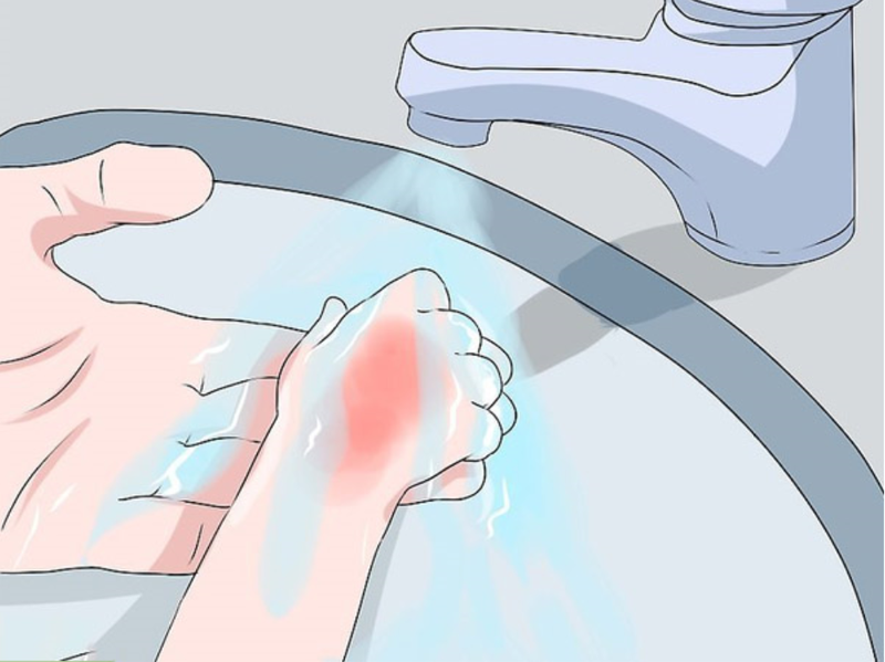 Khi trẻ bị bỏng cần ngay lập tức đặt khu vực bị bỏng trong nước mát nhưng không lạnh&nbsp;hoặc dưới vòi nước đang chảy