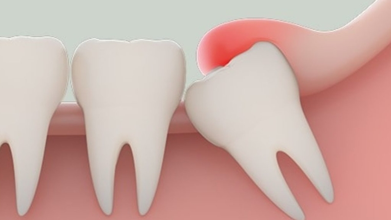 Một số lưu ý khi nhổ răng khôn mà bạn cần biết 1