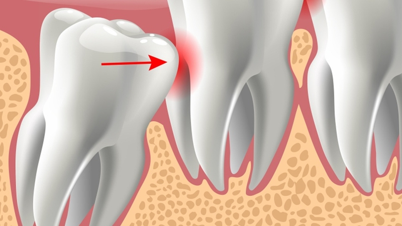 Một số lưu ý khi nhổ răng khôn mà bạn cần biết 2