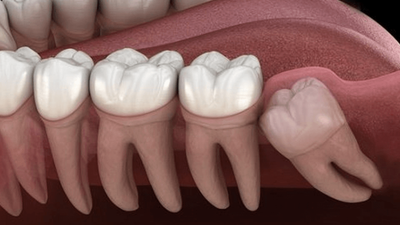 Một số lưu ý khi nhổ răng khôn mà bạn cần biết 3