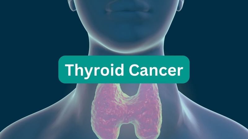 một số lưu ý về cuộc sống sau điều trị ung thư tuyến giáp 1