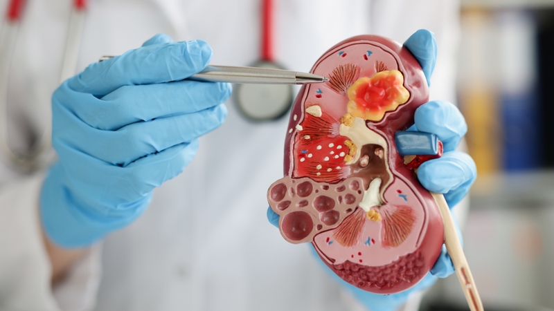 Bổ sung canxi quá liều hoặc kéo dài làm tăng nguy cơ hình thành sỏi thận