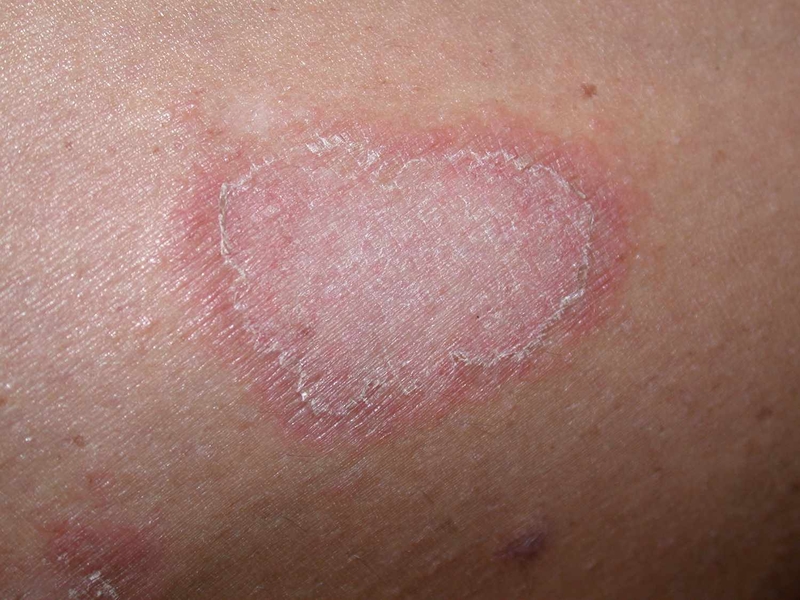 Thông tin cần biết về bệnh thấp tim? Làm sao để phòng ngừa bệnh? 2