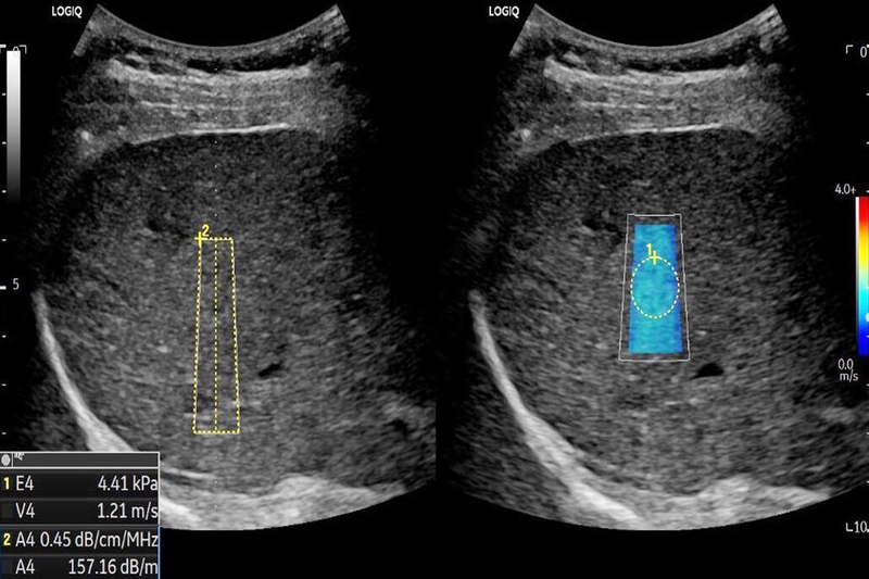 Một số thông tin về giãn bể thận ở thai nhi mẹ bầu cần lưu ý 1