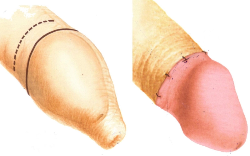 Một số tiêu chí chọn lựa địa chỉ cắt bao quy đầu 1