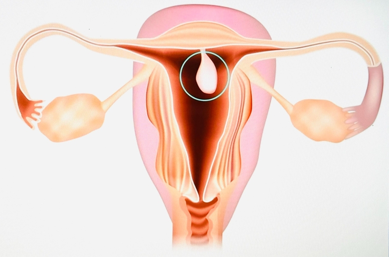 Một tháng có kinh 3 lần dấu hiệu của bệnh gì - 2