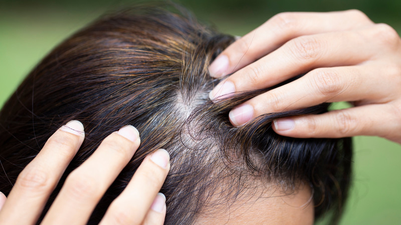 Nang tóc suy yếu không chỉ mọc ít tóc hơn mà sợi tóc mọc lên thường mỏng, yếu và dễ gãy