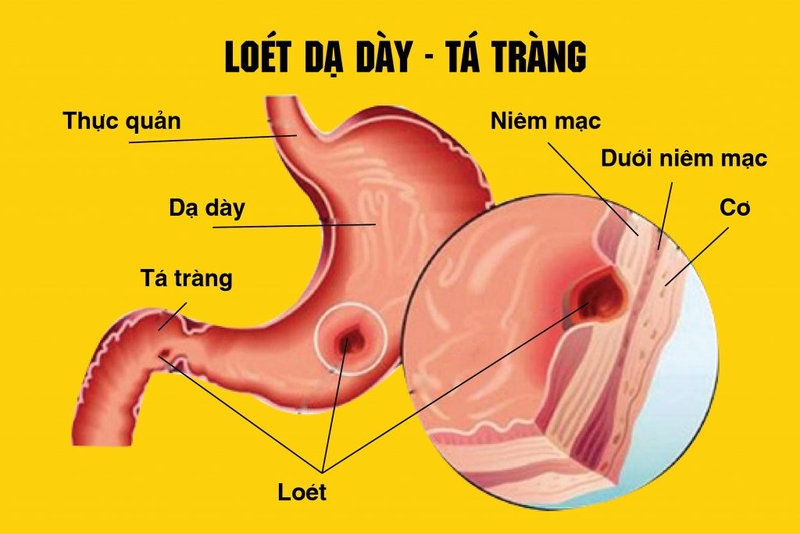 một số thuốc đặc trị viêm loét dạ dày tá tràng