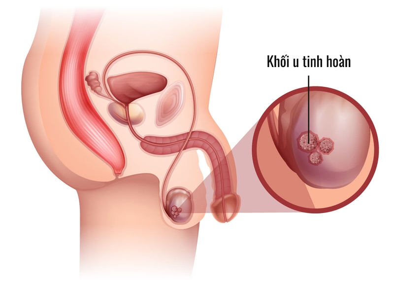 Một số bệnh lý có liên quan đến một tinh hoàn có cục nhỏ rắn không đau 3