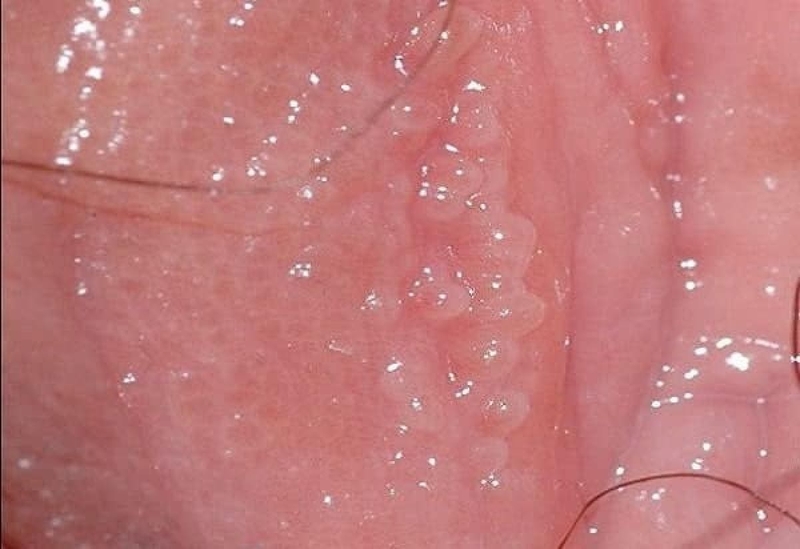 mot-vai-benh-de-gay-nham-lan-voi-sui-mao-ga 3.jpg