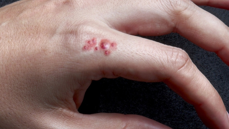 MRSA là gì? Nguyên nhân, dấu hiệu và cách điều trị khi nhiễm MRSA 2