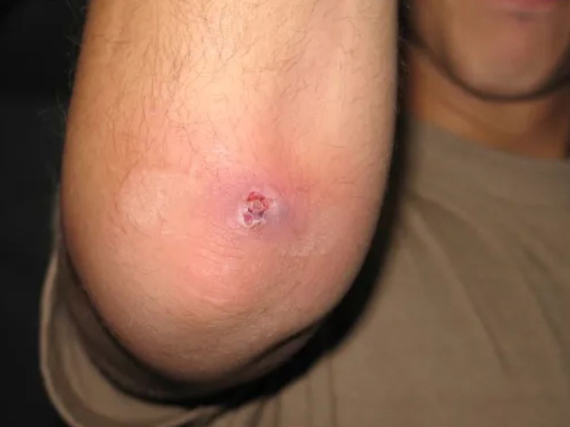 MRSA và cảnh báo những yếu tố nguy cơ nhiễm MRSA, chẩn đoán và cách phòng ngừa 1