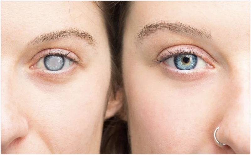 Mù ban ngày: Nguyên nhân, triệu chứng và phương pháp điều trị 2