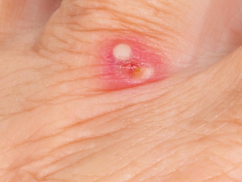 Mủ là gì? Nguyên nhân và triệu chứng của tình trạng mưng mủ 5