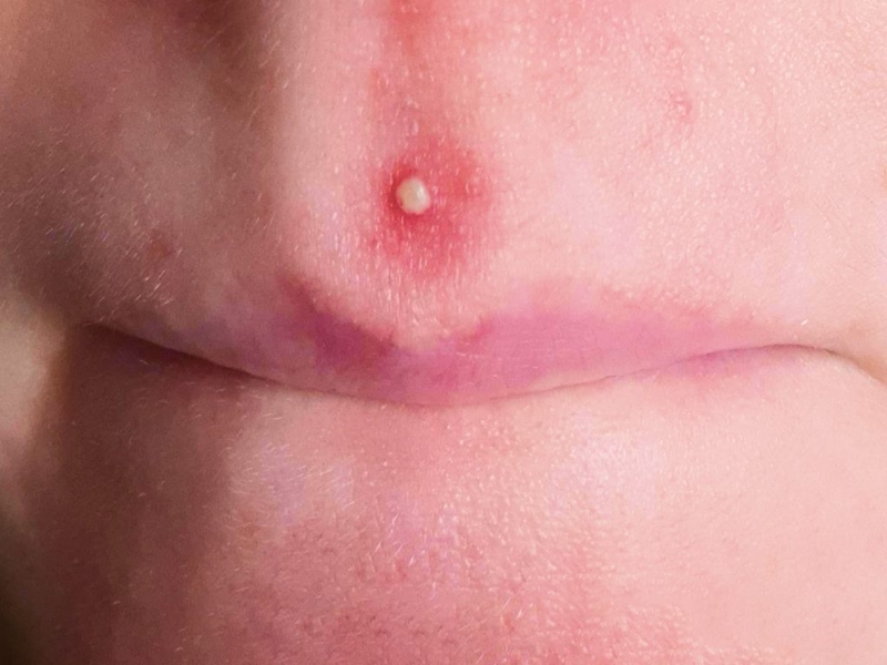 Mủ là gì? Nguyên nhân và triệu chứng của tình trạng mưng mủ 3