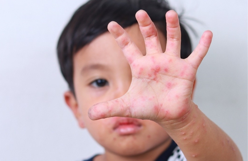 Mùa tay chân miệng cao điểm là khi nào? Cần làm gì để phòng bệnh 3