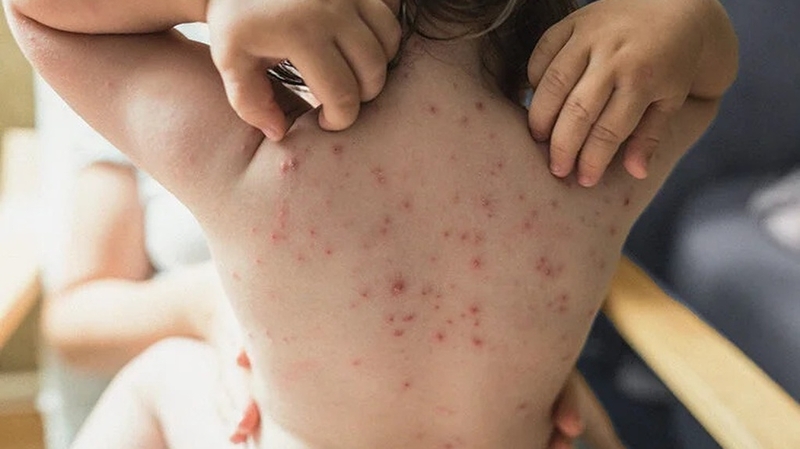 Mùa thủy đậu vào tháng mấy? Cách phòng ngừa bệnh hiệu quả 5