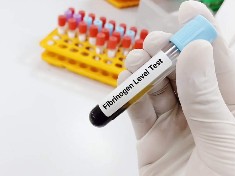 Mục đích và ý nghĩa lâm sàng của xét nghiệm Fibrinogen 3